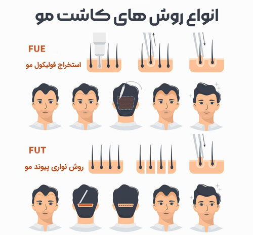 کاشت مو با چه روشی بهتر است
