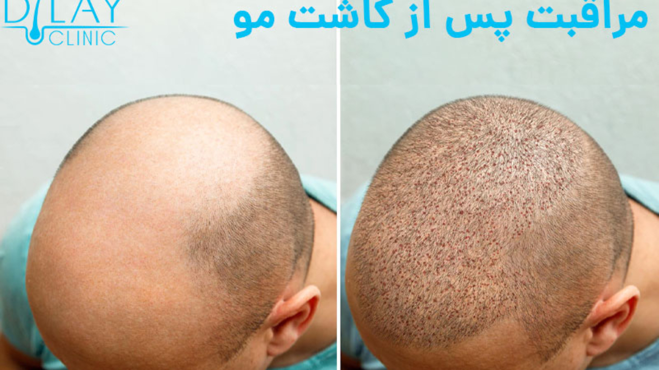 head-balding-man-before-after-hair-transplant-surgery-man-losing-his-hair-has-become_168410-1915