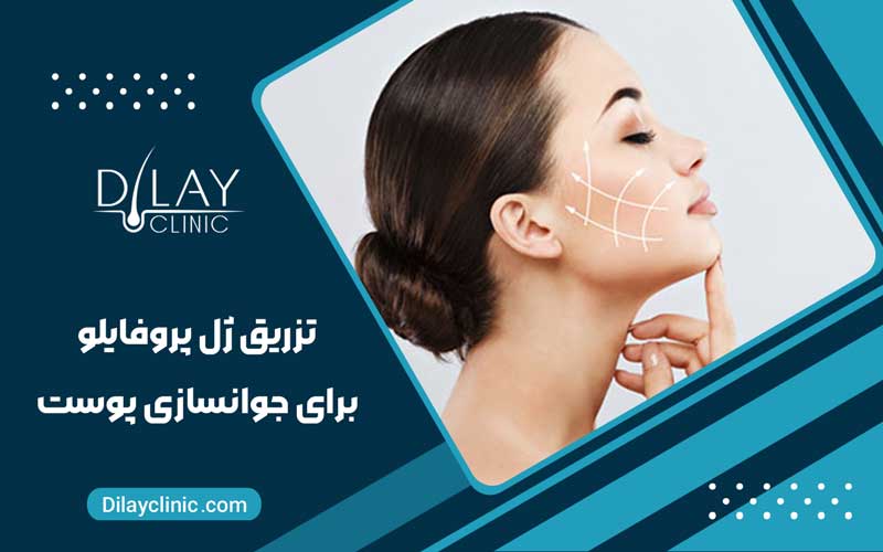 تزریق ژل پروفایلو برای جوانسازی پوست