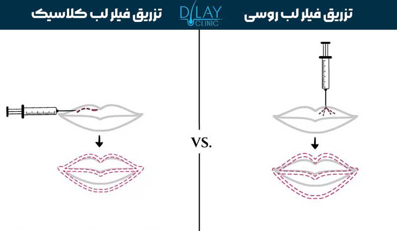 تفاوت فیلر لب روسی و فیلر لب معمولی